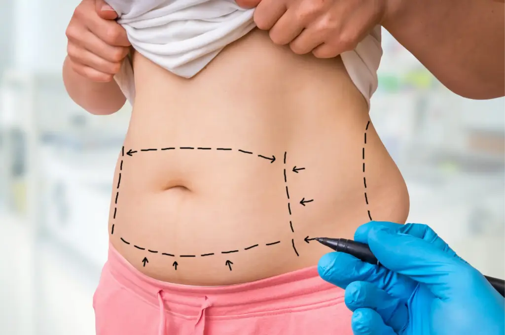 Body contouring surgery at Icon Aesthetics