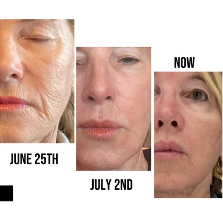 Gallery Before After face Patients three at Icon Aesthetics PLLC